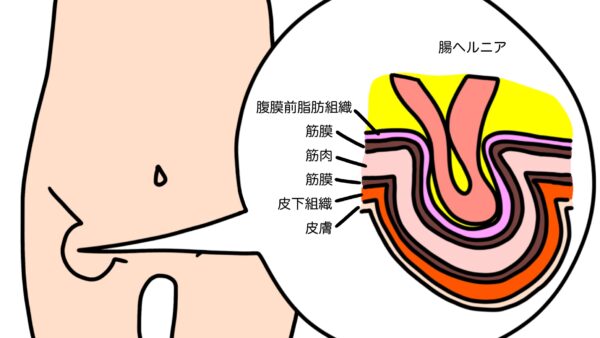 それからの、「鼠径ヘルニアかもしれない」